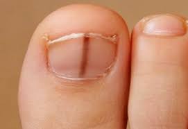 Listen Up Walkers And Runners – 'Black Toenails' Are Preventable! -  Footfriend